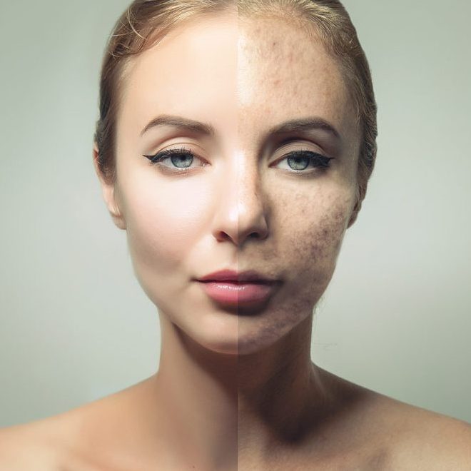 Acne Treatments