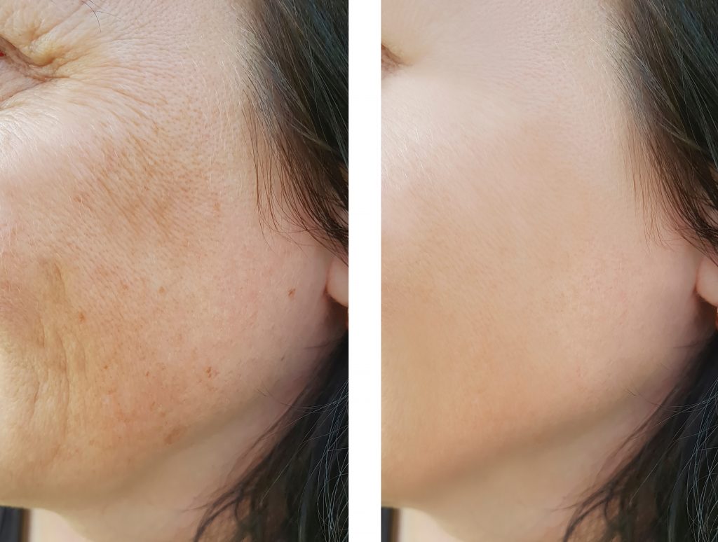 Pigmentation & Uneven Skin Tone Causes and Treatments - Revival Medi Spa